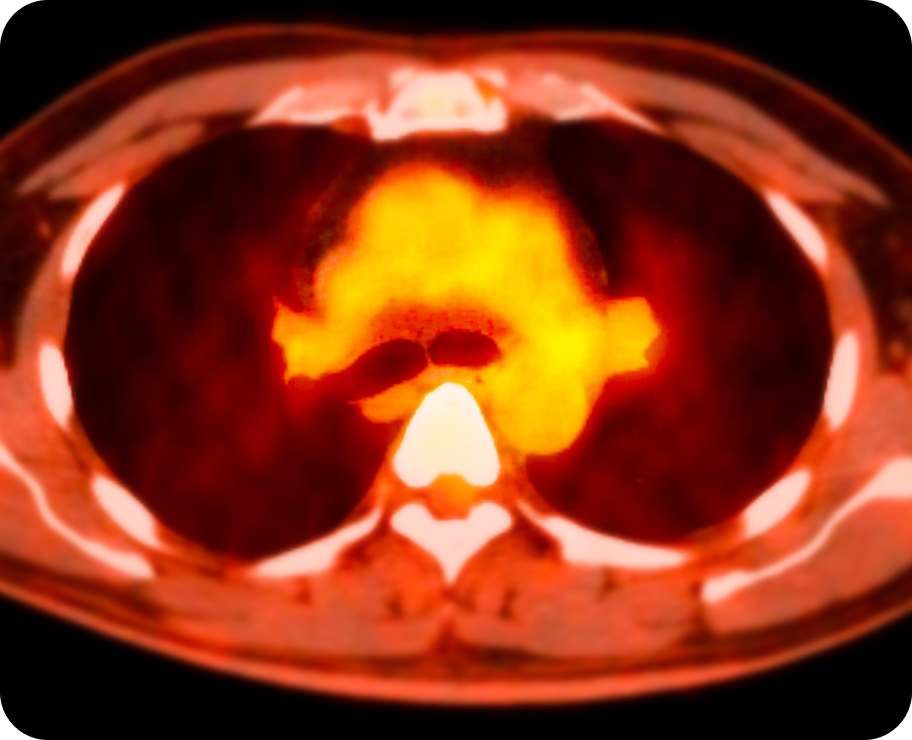 Hematologic Malignancies