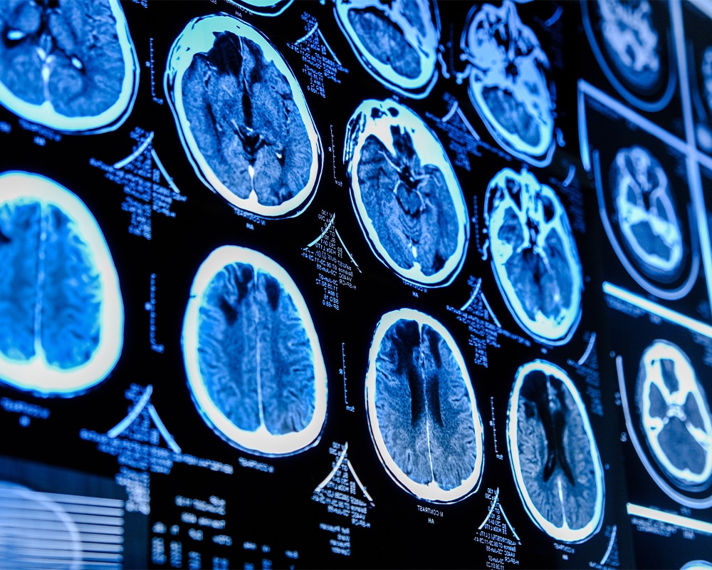 A close-up view of multiple brain scan images displayed on a screen, showcasing detailed medical imaging for analysis in a clinical or research setting.