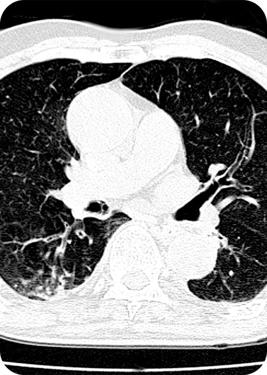 Pulmonary