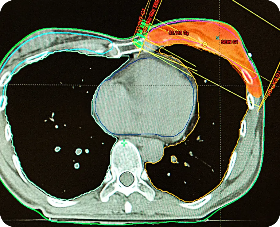 Solid Tumor