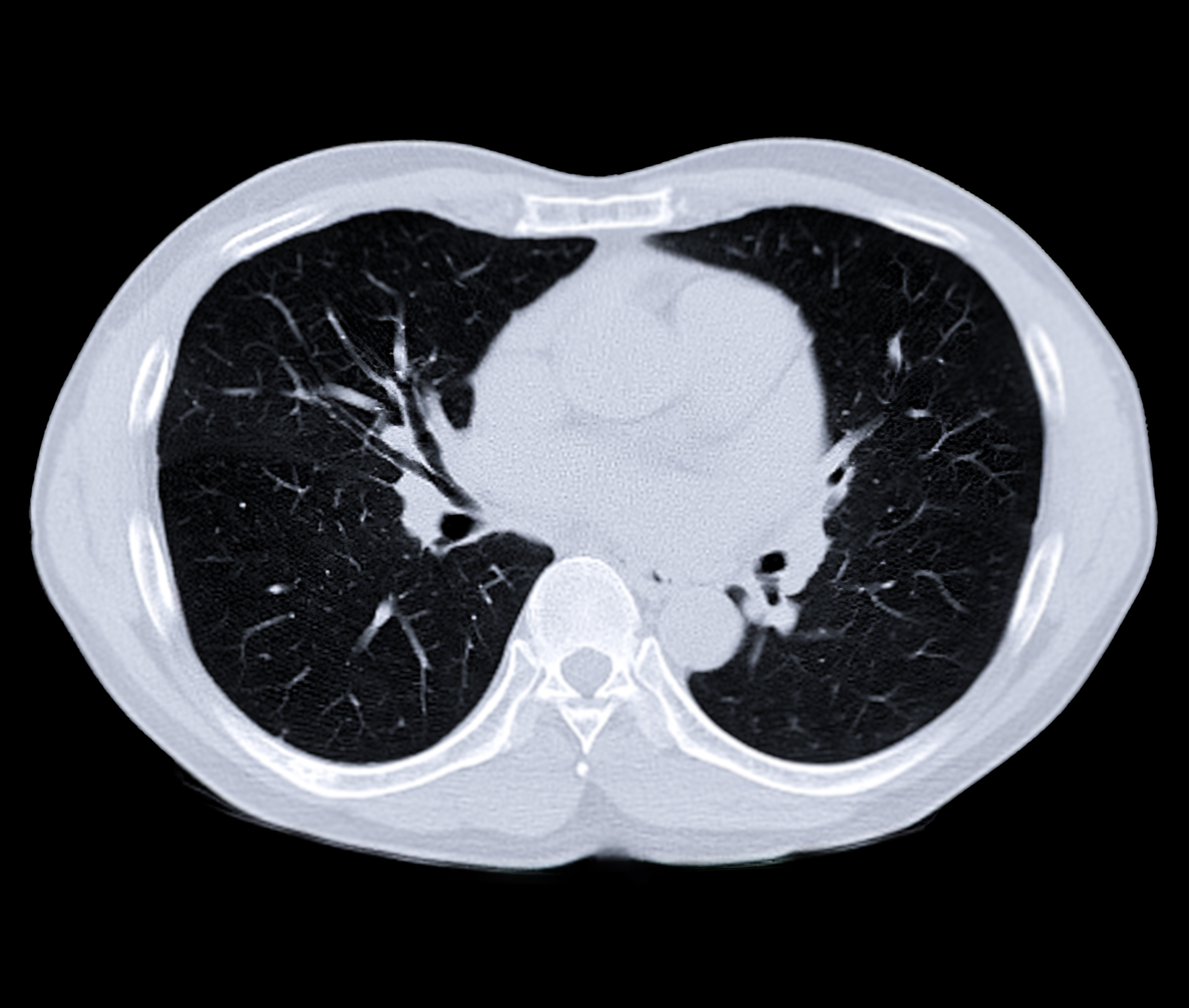 Managing Interstitial Lung Disease in ADC Clinical Trials Webinar