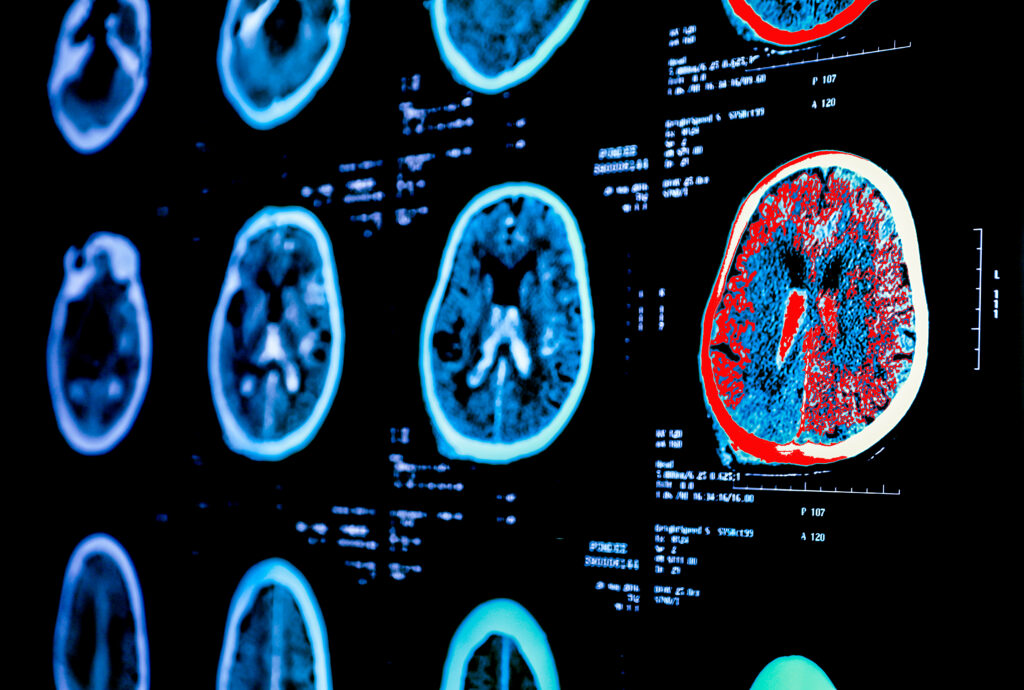 Your Trusted Imaging Partner for Alzheimer’s Disease Research